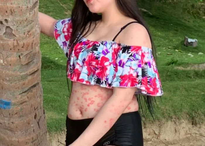 Woman Leaves "Friend's" Wedding After She's Called Out For Not Covering Up Her Skin Condition