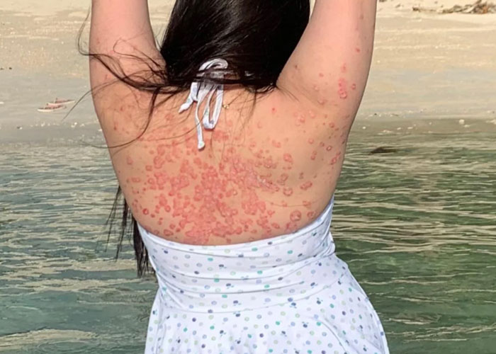 Woman Leaves "Friend's" Wedding After She's Called Out For Not Covering Up Her Skin Condition