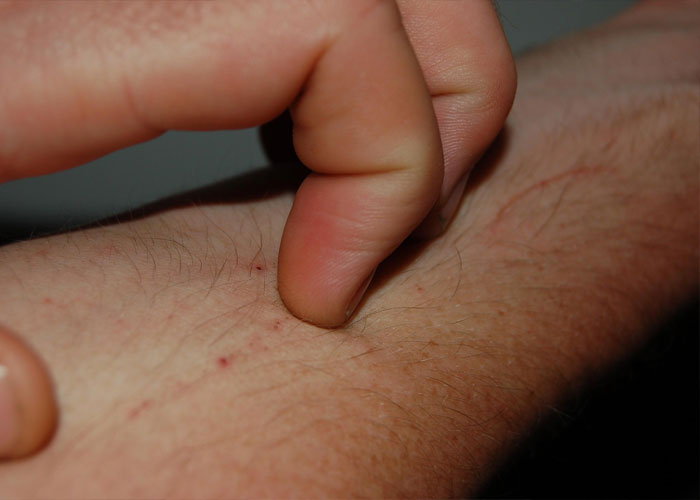 Woman Leaves "Friend's" Wedding After She's Called Out For Not Covering Up Her Skin Condition