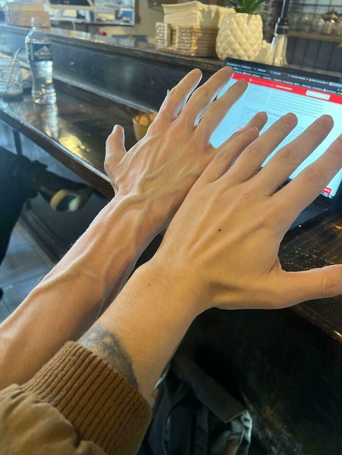 My Vasculature (Left), Compared To My Man Cody’s (Right)