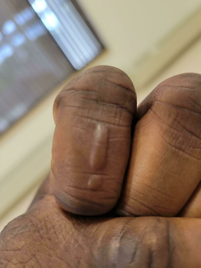 Random Blister That Looks Like An Exclamation Point Appeared On My Finger