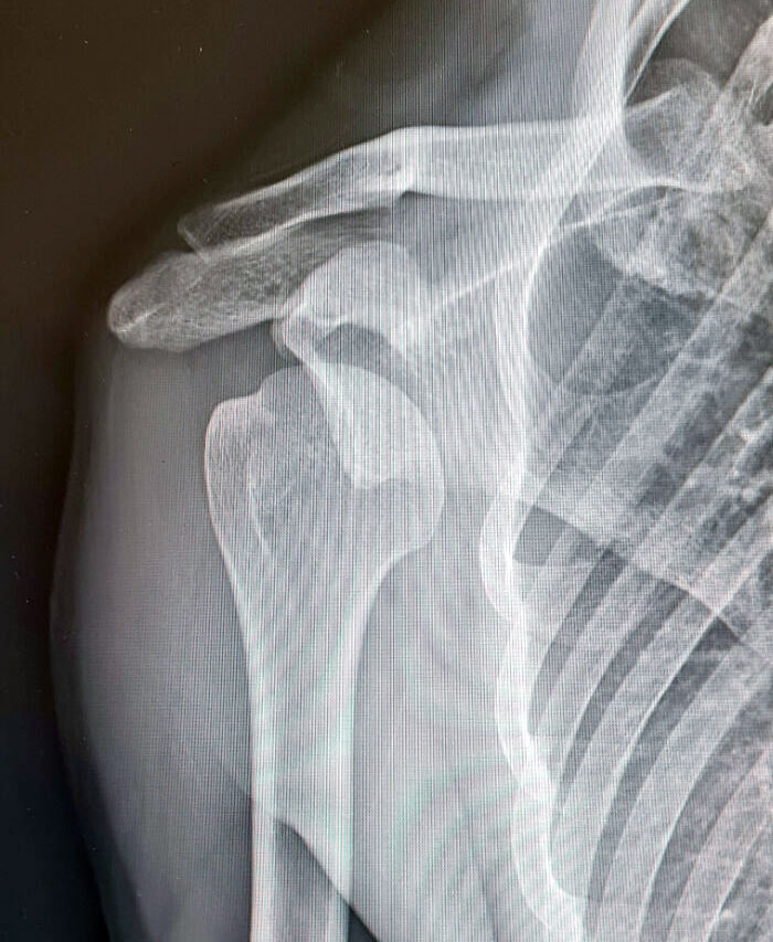 I Dislocated My Shoulder Yesterday And Got 2-Week Notice From My Employer Today, Because It's Going To Take Me About A Month To Heal