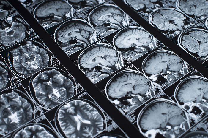 Multiple brain MRI scans displayed, symbolizing the complexity of gossip shared by 27 people in revealing pieces.