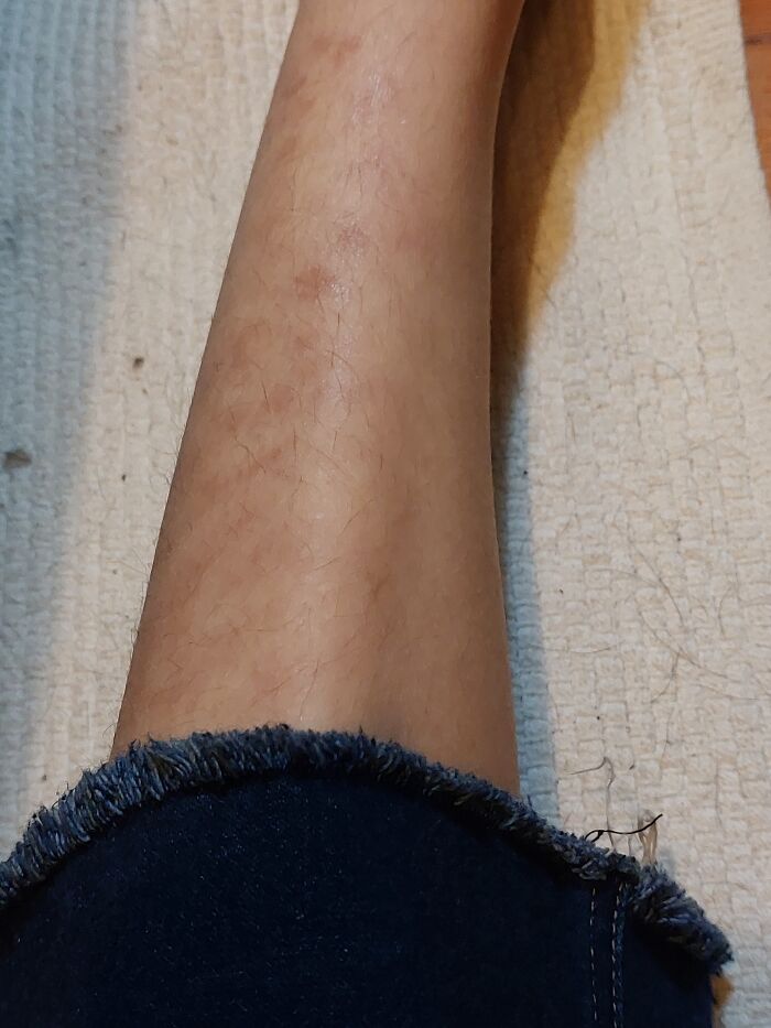 Not Exactly Cool But Interesting. It Gets Much Darker/Redder When It's Warmer Out, And No, It Is Not Scarring! I'll Explain In The Comments