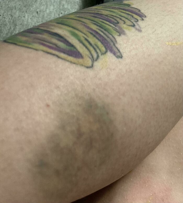 This Bruise Is All The Same Colors As My Tattoo (It’s A Tornado)