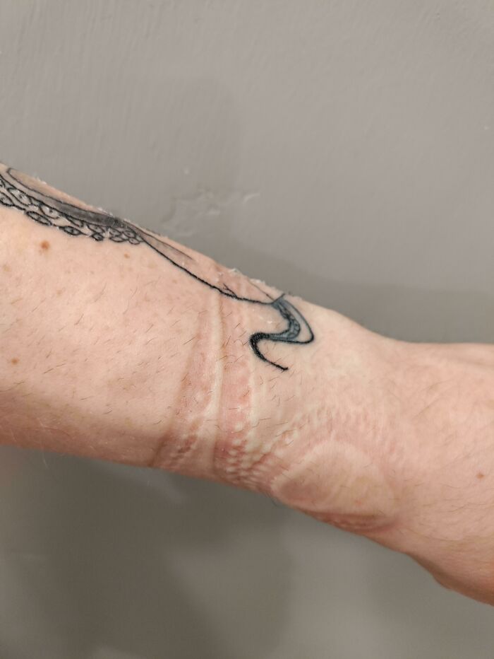The Mark From My Wrist Brace Kind Of Matches The Tentacles On My Tattoo