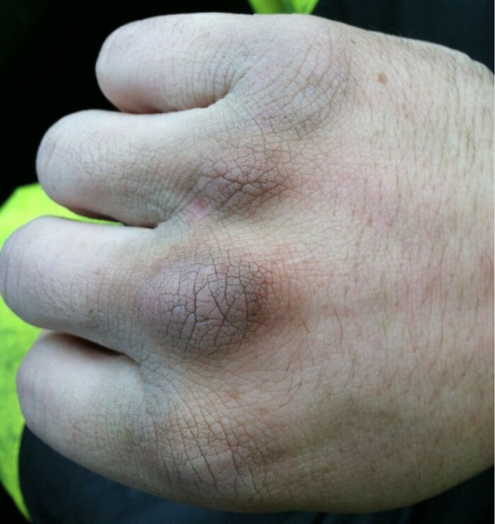 Be Nice To Your Trash Man When It's Raining And It's 30 Degrees Outside. We Are Not Invincible. This Is My Hand After Working 4 Hours In That Weather