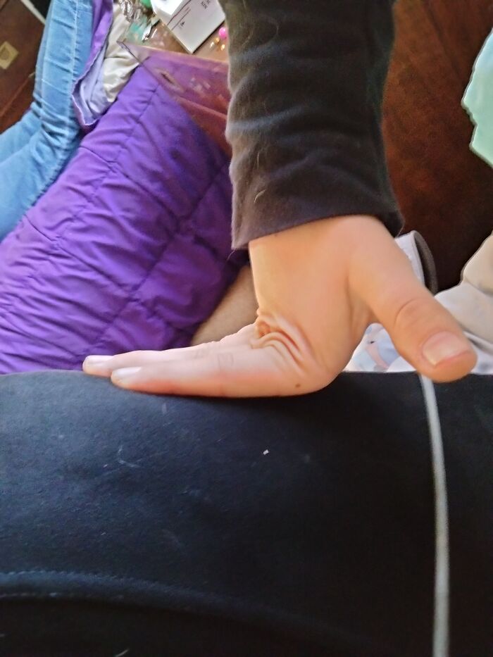 I Can Put Both My Hand's Fingers At A 90° Angle