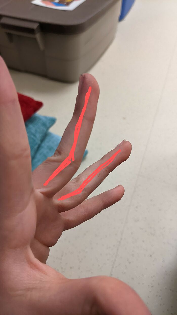 Bend The Tip Of My Finger Backwards But Not The Rest