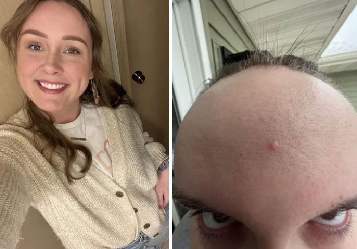 Funny before and after pics showing the same person smiling and then with a close-up of a forehead with a pimple.