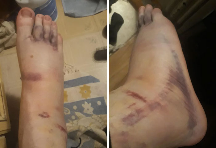 Mi tobillo 4 días después de un esguince