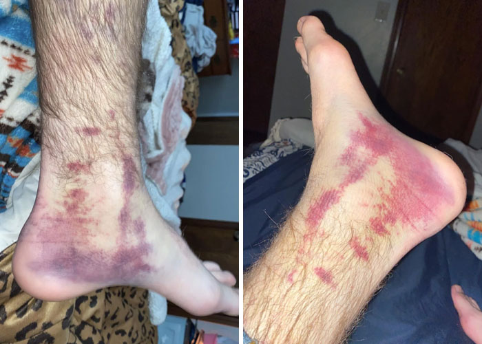 El radiólogo dijo que no había hueso roto... Soy un tanto escéptico