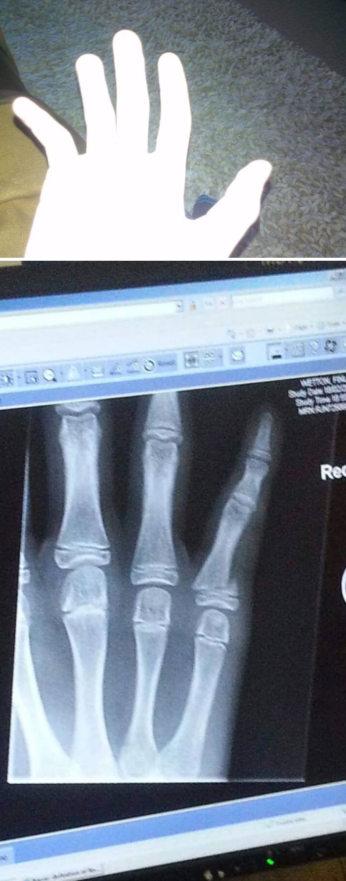 Me rompí el dedo buscando comida