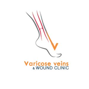 Varicose Veins