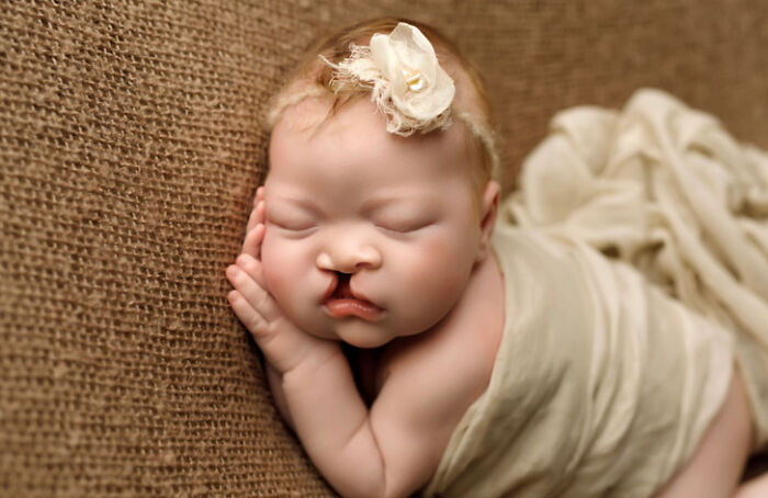 The Heart-Warming Story Of One Photograph: An Image Of A Baby With A Cleft Lip, Making Her Story Go Viral The Heart-Warming Story Of One Photograph: An Image Of A Baby With A Cleft Lip, Making Her Story Go Viral