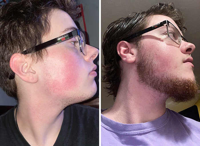 I'm Glad To See Some Beard Growth. 1 Year And 1 Month