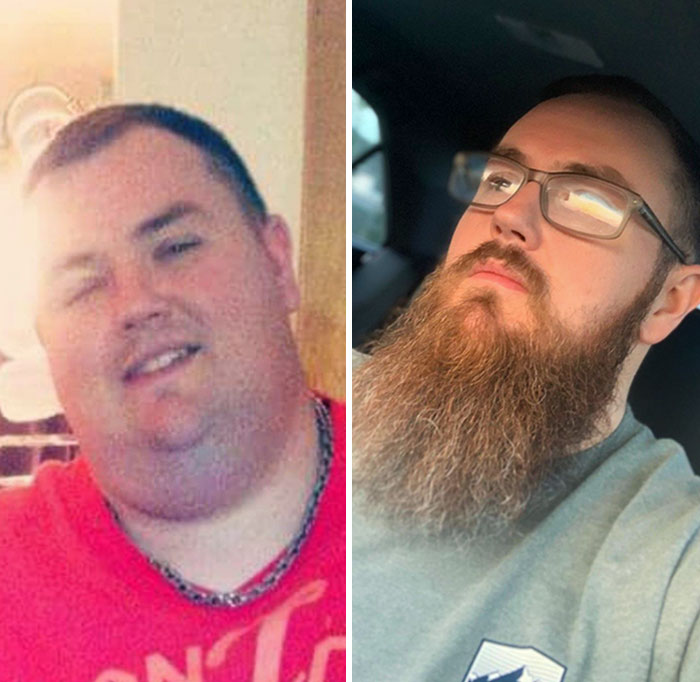 I Lost 230 Lbs And Gained A Beard To Cover Up My Turkey Neck Of Loose Skin