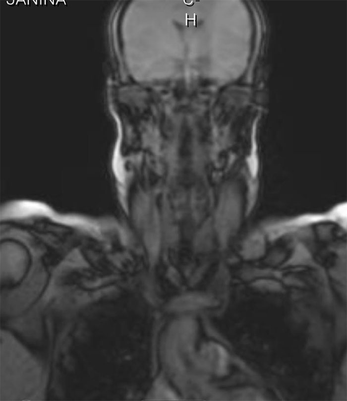 My Mri Exposes My Lion Within