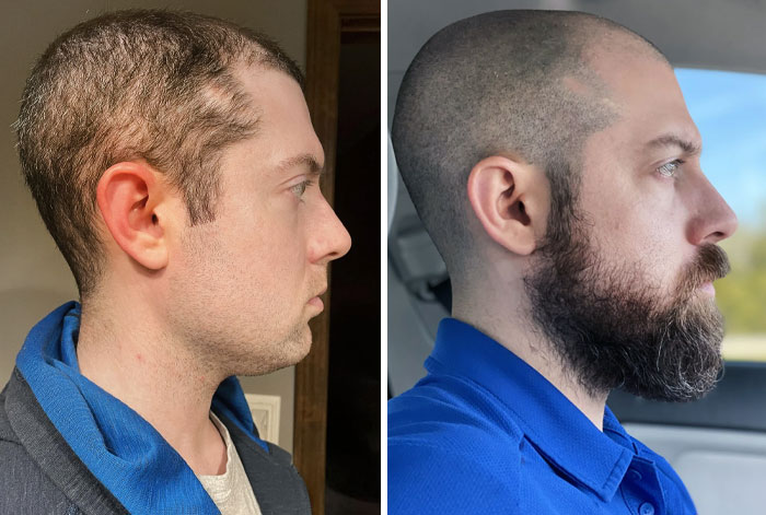 I Had A Hair Loss But Acquired A Beard