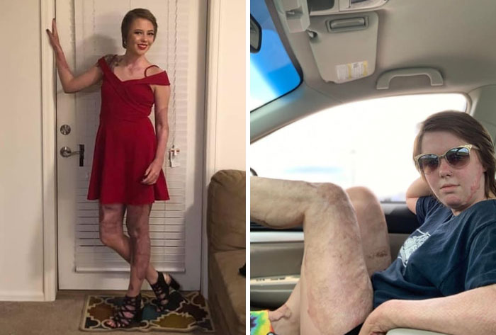 Hey Mom, I Wore A Dress For The First Time Since I Was In An Explosion. It Was So Scary Showing My Scars For The First Time. But I Did It And I Still Felt Beautiful