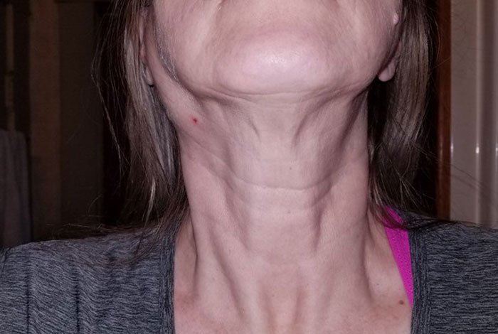 "Started Forgetting Words": 30 People Share Early Signs Of Cancer To Look Out For