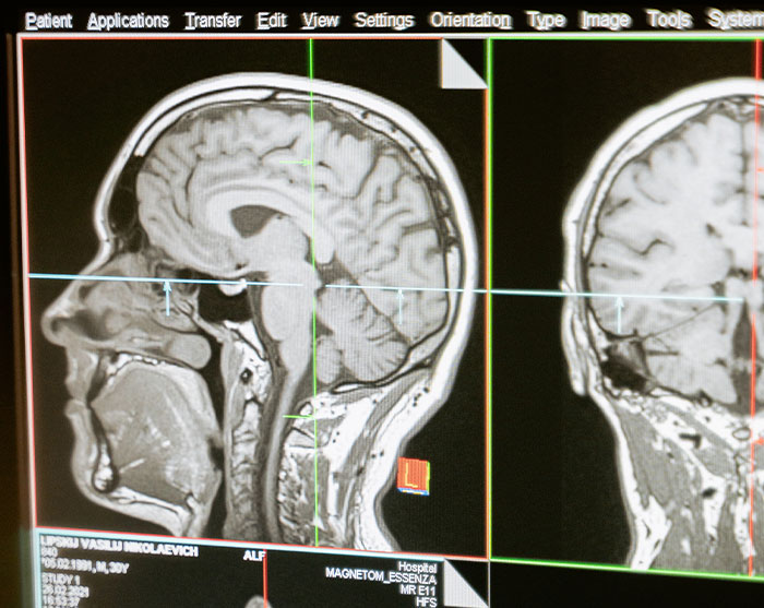 "Started Forgetting Words": 30 People Share Early Signs Of Cancer To Look Out For