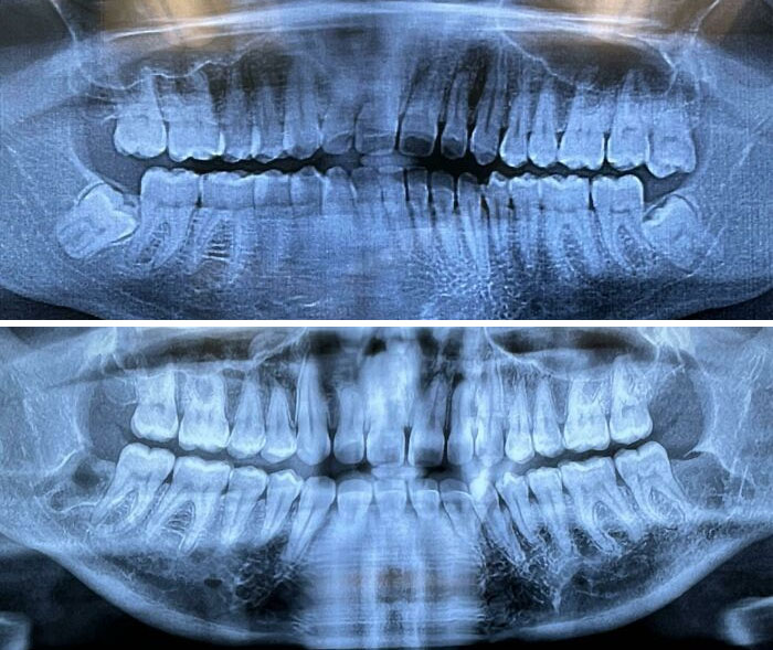 A Week Before Wisdom Teeth Extraction vs. A Week After