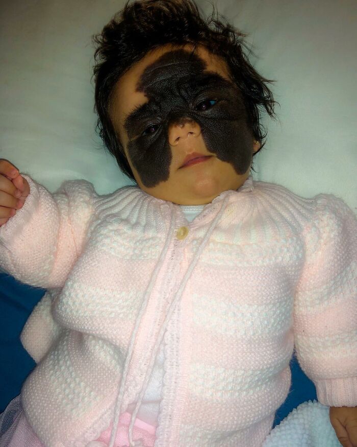 This 4-Year-Old Girl Has Undergone Multiple Surgeries To Get A Dangerous Birthmark Removed From Her Face This 4-Year-Old Girl Has Undergone Multiple Surgeries To Get A Dangerous Birthmark Removed From Her Face