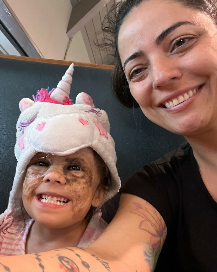 This 4-Year-Old Girl Has Undergone Multiple Surgeries To Get A Dangerous Birthmark Removed From Her Face This 4-Year-Old Girl Has Undergone Multiple Surgeries To Get A Dangerous Birthmark Removed From Her Face