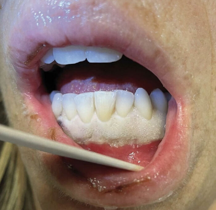 Completely White Gums! A 48-Year-Old Woman Went To The Hospital Complaining Of Fatigue And Painful, Swollen Gums That Were All White