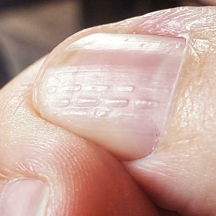 My Thumb Nail Has Ridges
