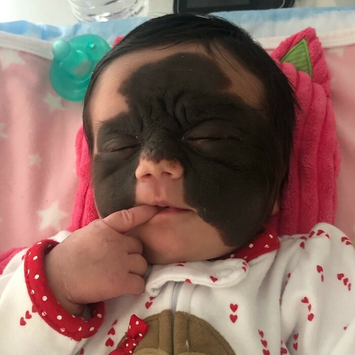 This 4-Year-Old Girl Has Undergone Multiple Surgeries To Get A Dangerous Birthmark Removed From Her Face This 4-Year-Old Girl Has Undergone Multiple Surgeries To Get A Dangerous Birthmark Removed From Her Face