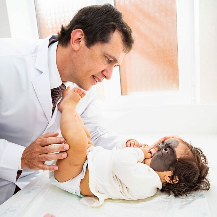 This 4-Year-Old Girl Has Undergone Multiple Surgeries To Get A Dangerous Birthmark Removed From Her Face This 4-Year-Old Girl Has Undergone Multiple Surgeries To Get A Dangerous Birthmark Removed From Her Face