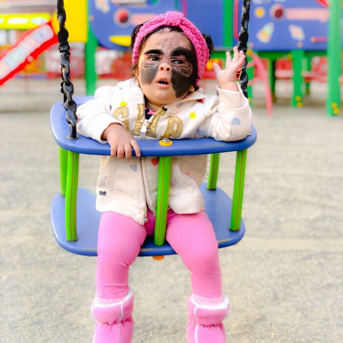 This 4-Year-Old Girl Has Undergone Multiple Surgeries To Get A Dangerous Birthmark Removed From Her Face This 4-Year-Old Girl Has Undergone Multiple Surgeries To Get A Dangerous Birthmark Removed From Her Face