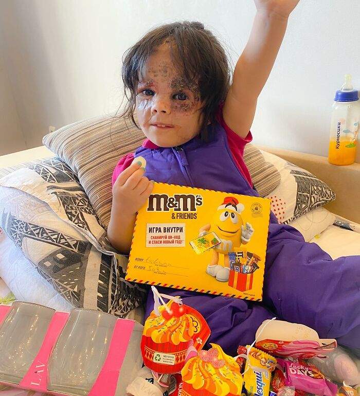 This 4-Year-Old Girl Has Undergone Multiple Surgeries To Get A Dangerous Birthmark Removed From Her Face This 4-Year-Old Girl Has Undergone Multiple Surgeries To Get A Dangerous Birthmark Removed From Her Face