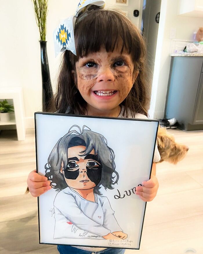 This 4-Year-Old Girl Has Undergone Multiple Surgeries To Get A Dangerous Birthmark Removed From Her Face This 4-Year-Old Girl Has Undergone Multiple Surgeries To Get A Dangerous Birthmark Removed From Her Face