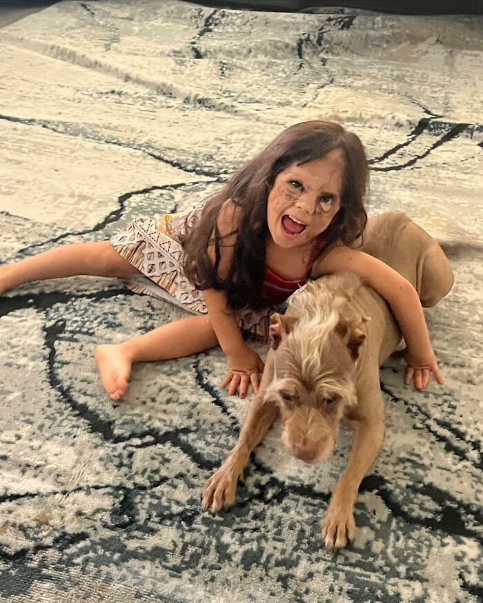 This 4-Year-Old Girl Has Undergone Multiple Surgeries To Get A Dangerous Birthmark Removed From Her Face This 4-Year-Old Girl Has Undergone Multiple Surgeries To Get A Dangerous Birthmark Removed From Her Face