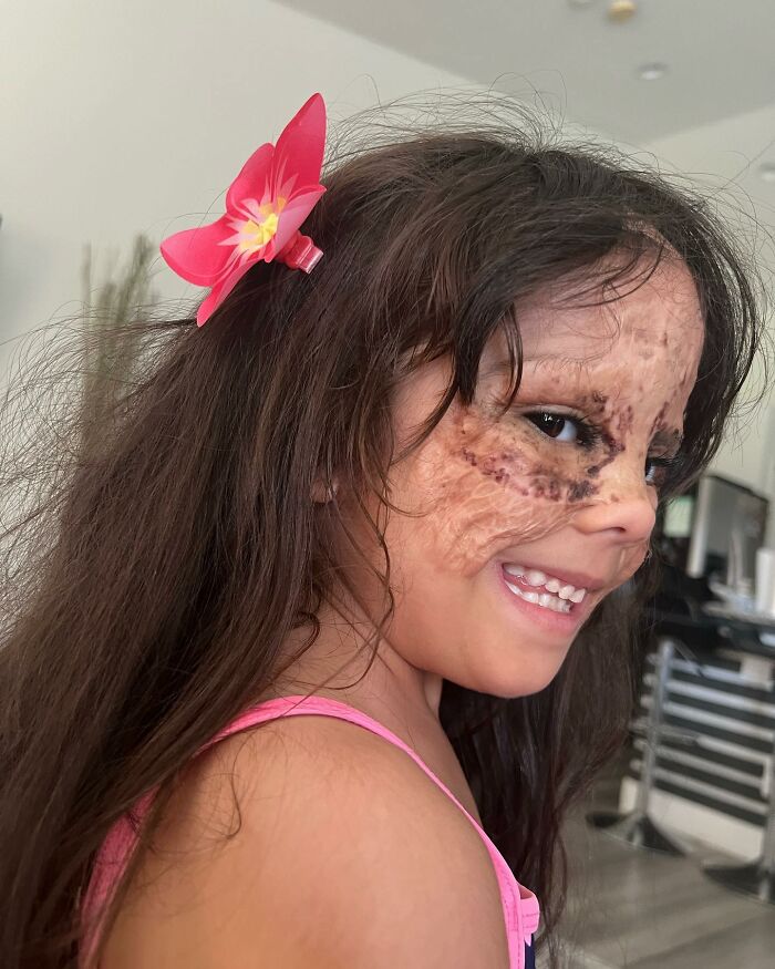 This 4-Year-Old Girl Has Undergone Multiple Surgeries To Get A Dangerous Birthmark Removed From Her Face This 4-Year-Old Girl Has Undergone Multiple Surgeries To Get A Dangerous Birthmark Removed From Her Face