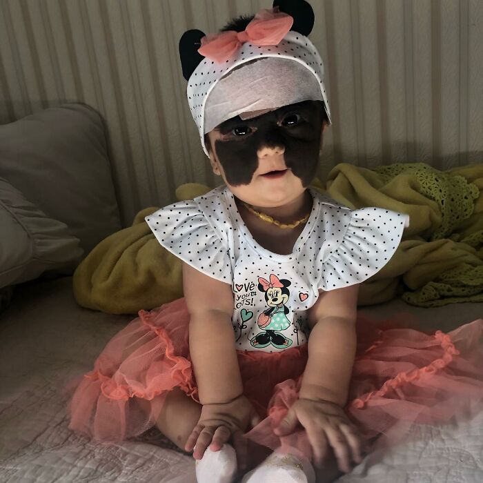 This 4-Year-Old Girl Has Undergone Multiple Surgeries To Get A Dangerous Birthmark Removed From Her Face This 4-Year-Old Girl Has Undergone Multiple Surgeries To Get A Dangerous Birthmark Removed From Her Face