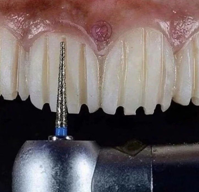 Cursed meme featuring a close-up of teeth with a dental drill positioned in front.