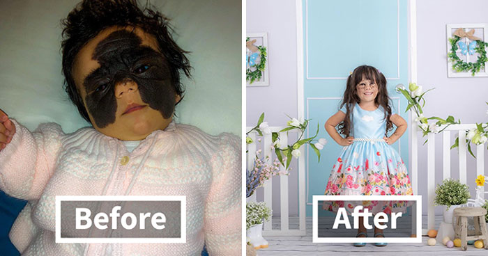 This 4-Year-Old Girl Has Undergone Multiple Surgeries To Get A Dangerous Birthmark Removed From Her Face