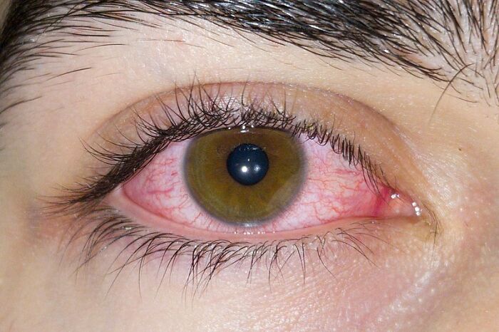 Close-up of a human eye with visible redness and irritation, illustrating human stupidity in a medical context.