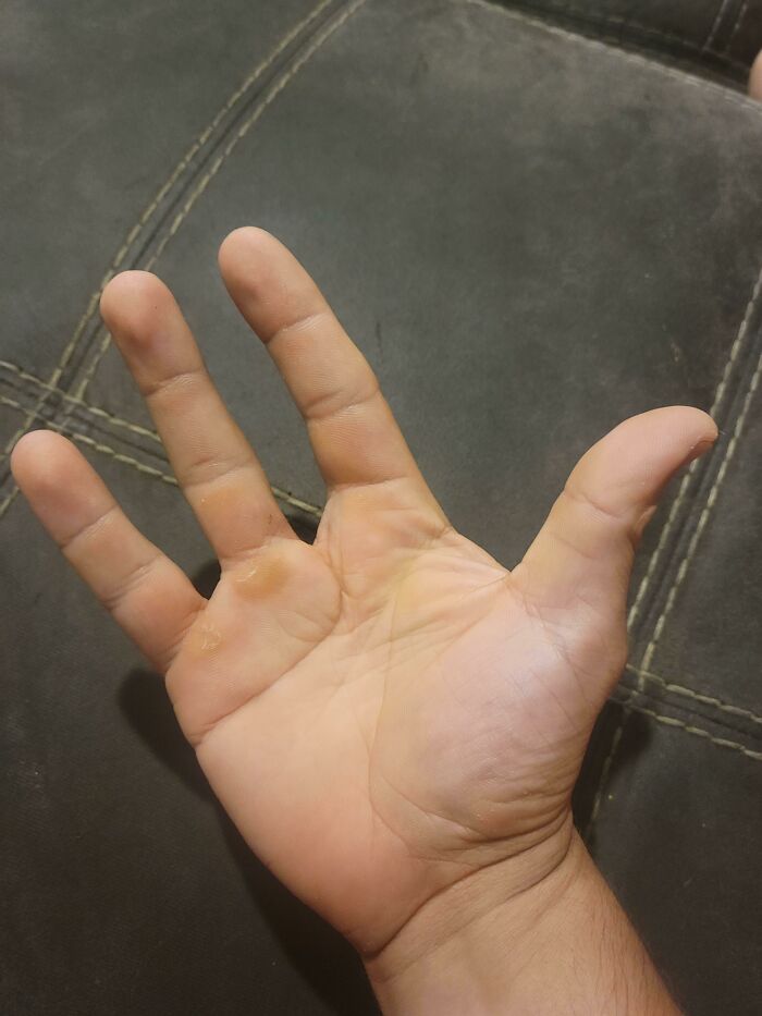 Human hand with six fingers displayed against a dark stitched surface, a weirdest pic from an online group.