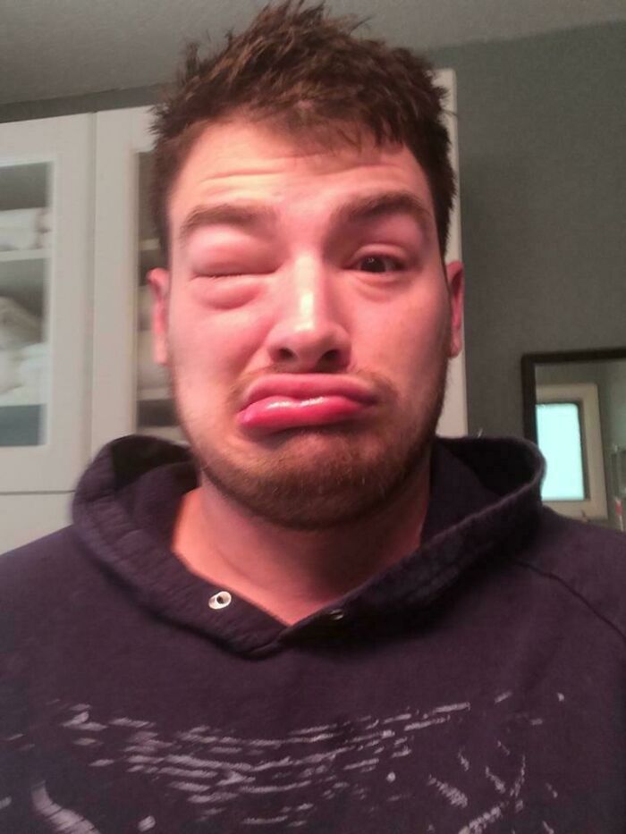 Soy alérgico a los gatos y me dormí sobre una manta de gatos