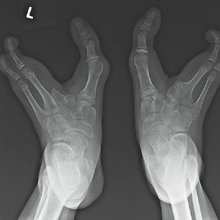 X-ray of modified hands of the 'Black Alien' highlighting unique bone structure in a clinical setting. X-ray of modified hands of the 'Black Alien' highlighting unique bone structure in a clinical setting.