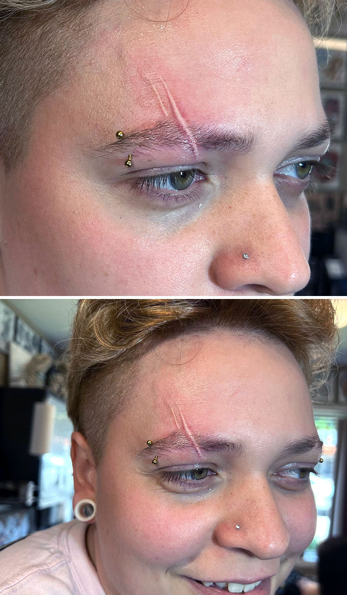 Cosmetic Scar