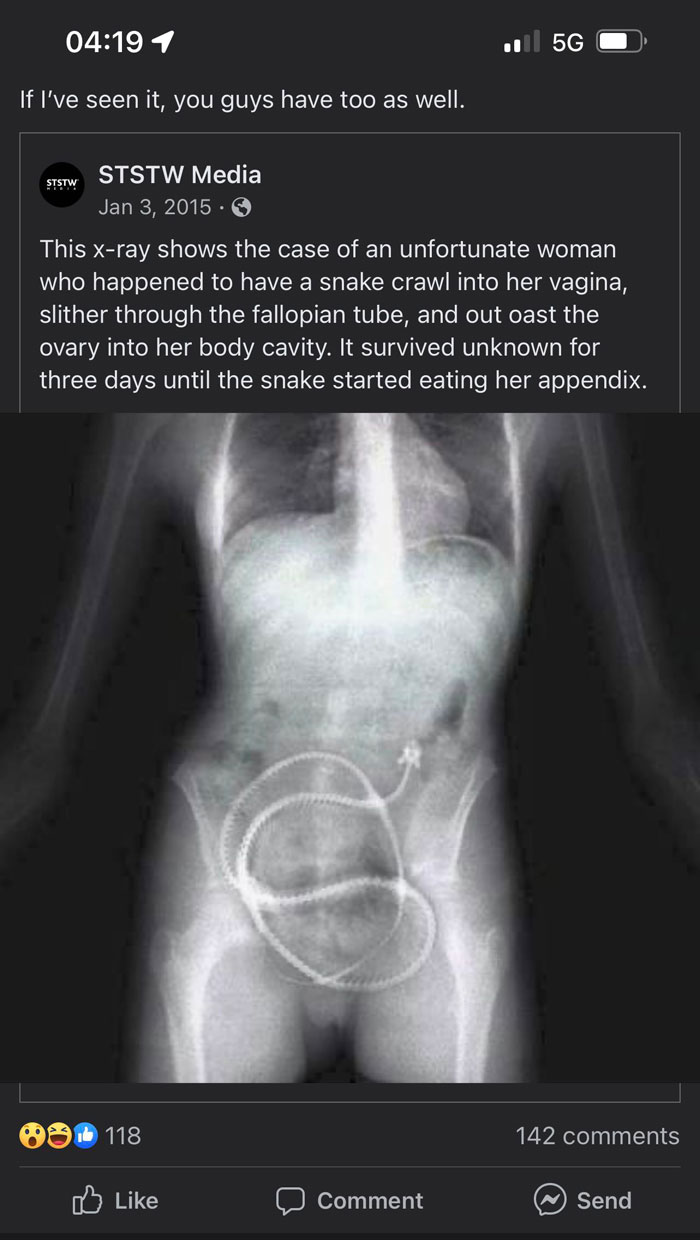 I Thought Snakes Needed Air To Breathe? Also The Snake Wouldn’t Fit Into A Fallopian Tube