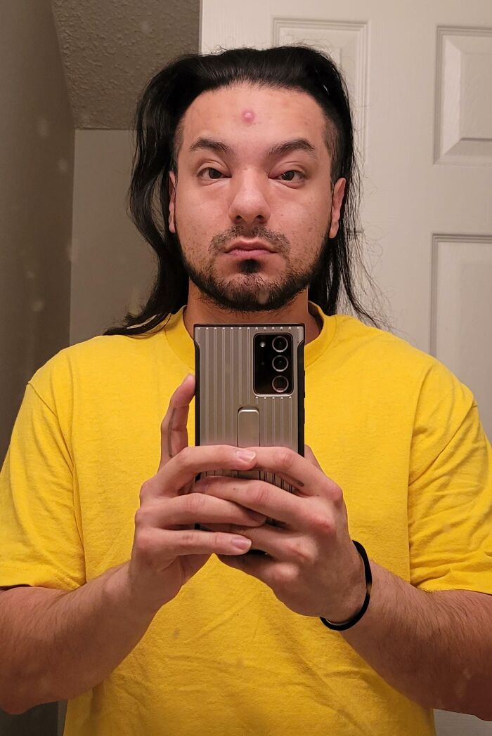 I Had A Cystic Pimple On My Forehead That Swole Up Pretty Good. Then The Swelling Migrated Down And Now I Look Like An Animorph
