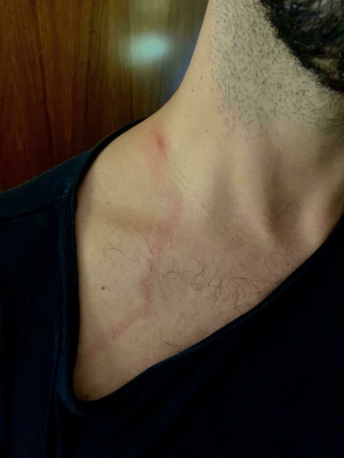 Got Stung On My Neck, Now It Is Making Its Way Into My Lymphatic System