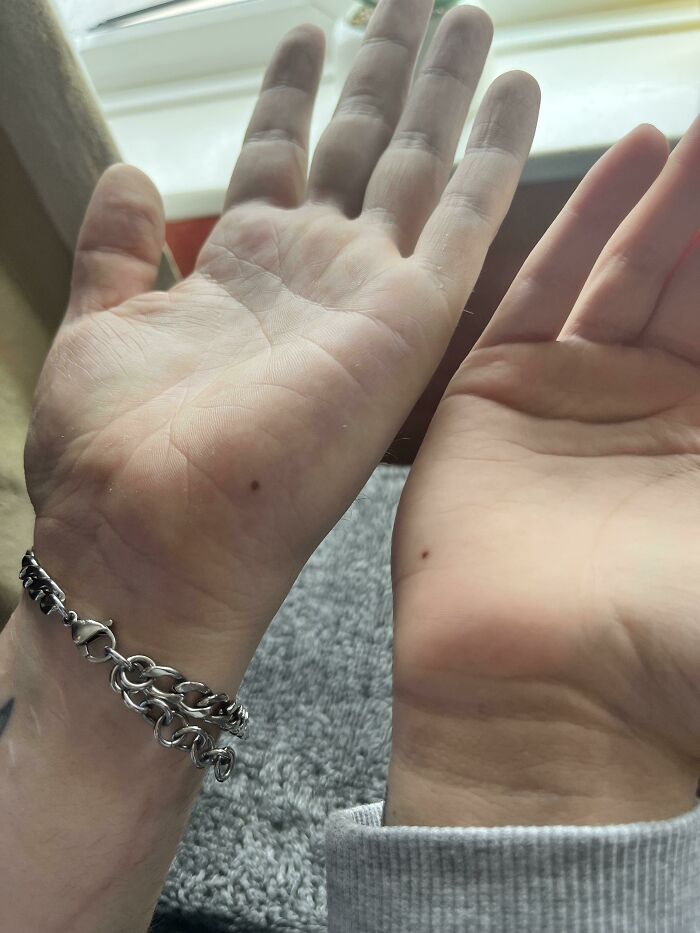 Me And My BF Have The Same Mole On Opposite Hands